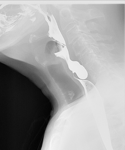 Image of pharyngeal pouch