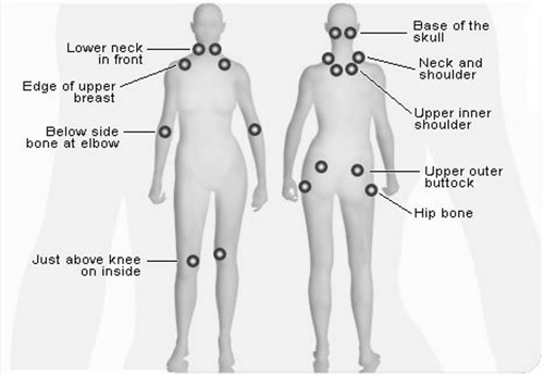 Diagram of tender areas in fibromyalgia