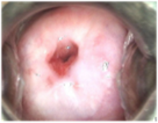 Prior Letz treatment